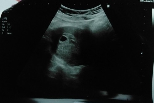 ท้องได้9 สัปดาห์ มีน้ำปนเลือดออกแต่ไม่เยอะตอนนี้แม่รู้สึกกังวลมากค่ะ