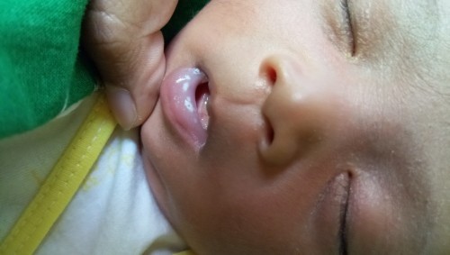 Bun, kira2 klo mulut anak saya ada kyk putih2 kyk gini akibat air susu yg dak di bersihin ap knp ya?