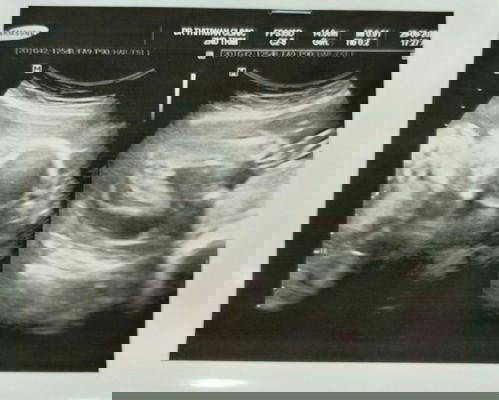23 week อัลตราซาวนด์