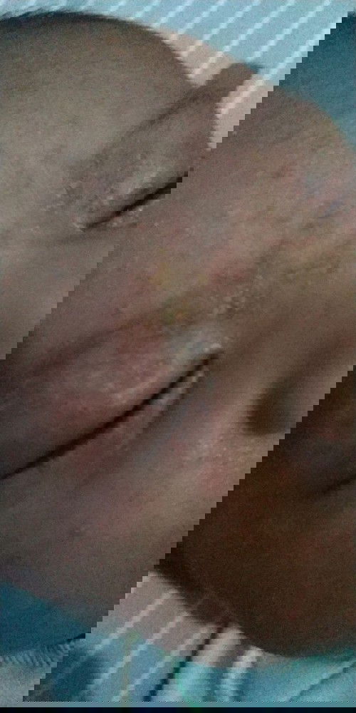 Bintik bintik pada bayi