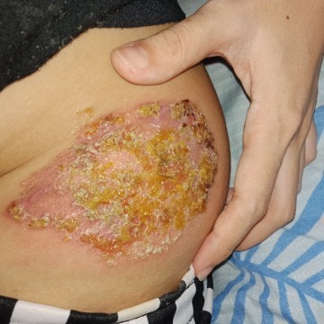 Eczema po ba?