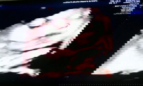 TD tinggi dan BB janin kurang