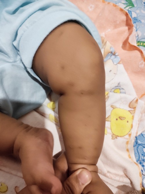 bekas gigitan nyamuk