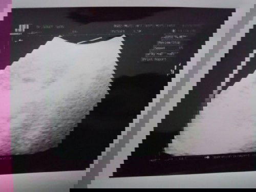 Hml 11mggu.usg ktanya aq hmil kosong g ada janin.dan hrs kuret.apkh ada yg SM dgnku?sdh bnget rsanya