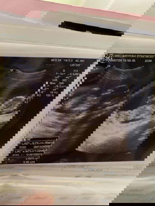 Sharing Hamil Kembar