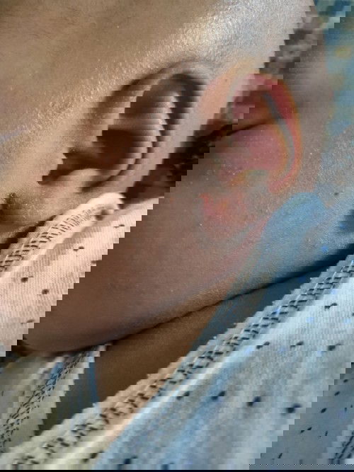 gatal gatal diwajah dan tangan