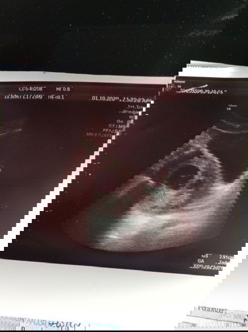 Hye all Mom boleh bagi pencerahan tentang hasil scan saya yg berjarak 9 hari ini