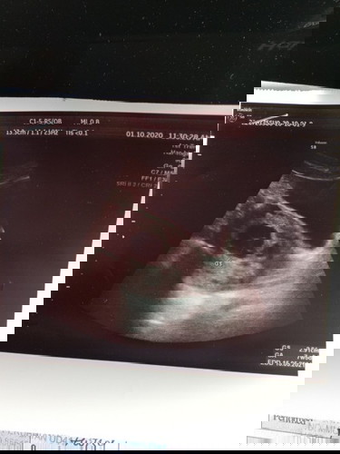 Hye all Mom boleh bagi pencerahan tentang hasil scan saya yg berjarak 9 hari ini