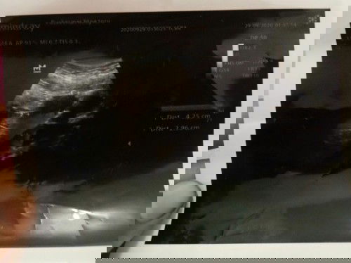 Kehamilan ,tespek negatif,usg kosong