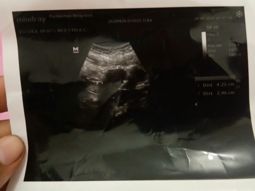 Kehamilan ,tespek negatif,usg kosong