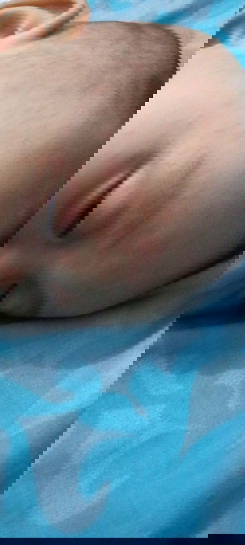 Bintik2 merah di wajah dan kulit kepala selepas demam