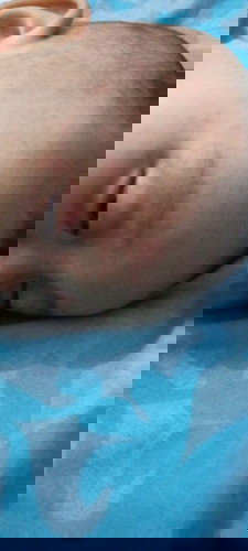 Bintik2 merah di wajah dan kulit kepala selepas demam