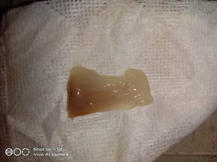 DISCHARGE /Mucus plug