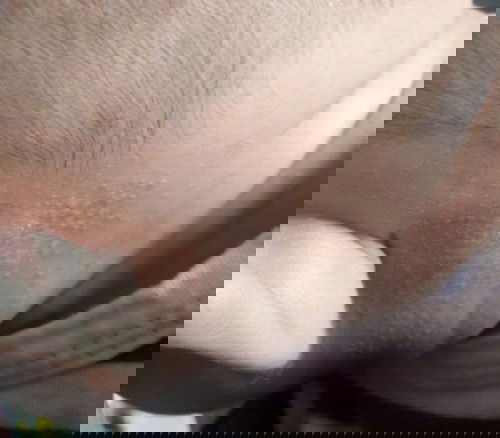 beruntusan di belakang telinga