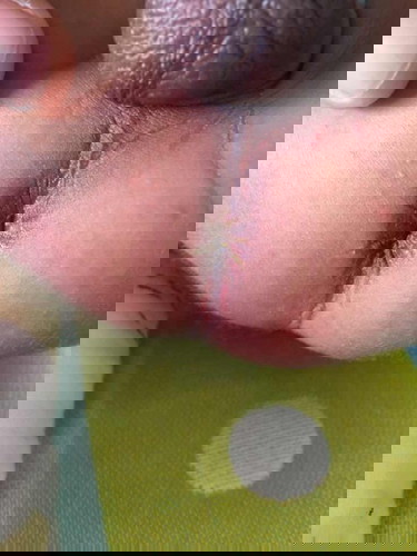 เป็นแผลที่ก้นค่ะ รูปใต้คอมเม้นนะคะ