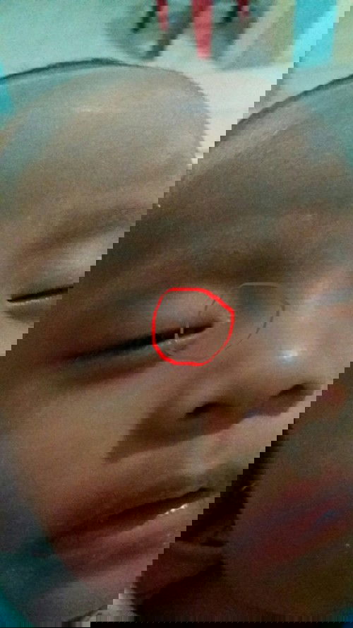 Bintik putih seperti jerawat