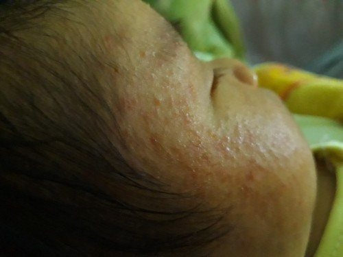 Bé bị chàm sữa dùng thuốc gi tốt và hiêu quả