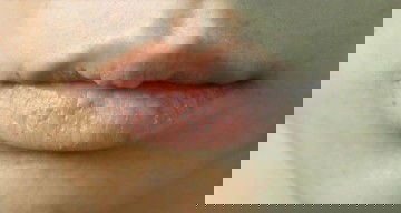 Bibir kering dan sariawan