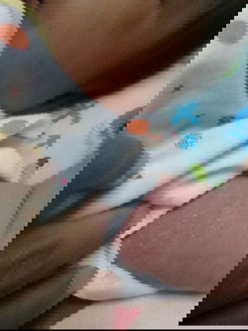 Alergi atau biang keringat?