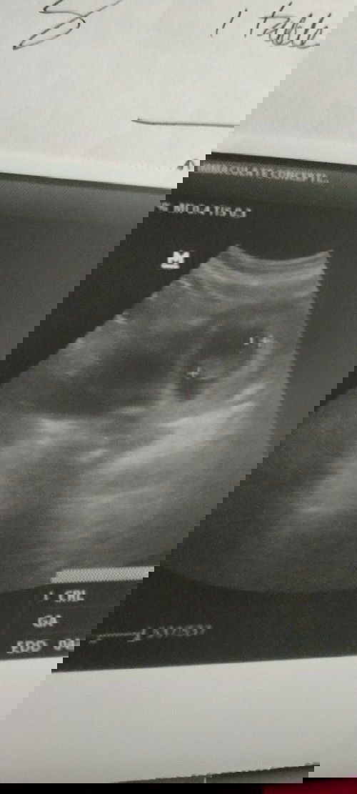 10weeks and 1day
Sino same case here di pa feel.yong pitik.
Na sinasabi nila first time.mom?