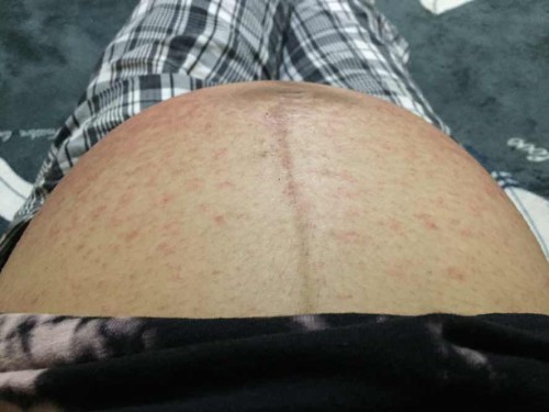 เป็นผื่นคันท้องได้37+1