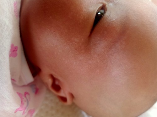 น้อง1เดือนเป็นกลากน้ำนมขาวๆบนหน้า ใช้ครีมอะไรทำยังไงถึงจะหายค่ะ