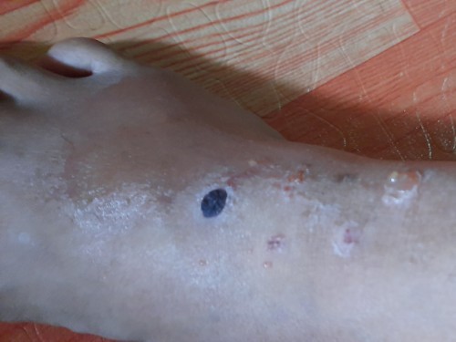 Foot Heat rash