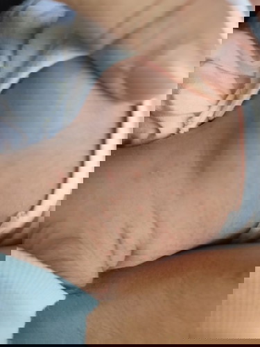 Skin Allergy???