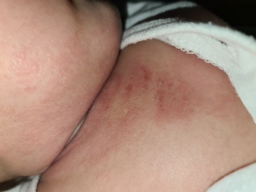 Rashes on chest