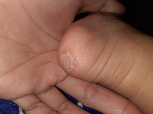 เท้าแตกควรทำยังไงดีค่ะ