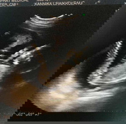 20week+3 ป๋มชอบนอนคว่ำหน้า แม่เลยได้เห็นแค่ข้างๆ