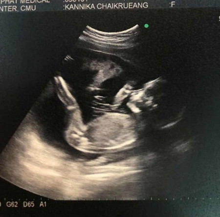20week+3 ป๋มชอบนอนคว่ำหน้า แม่เลยได้เห็นแค่ข้างๆ