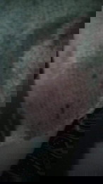 25 weeks pregnant w/ polyp