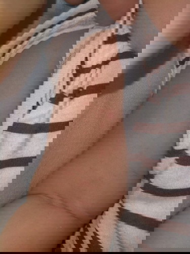 ผื่นออกตามแขน ขา ลูกน้อย