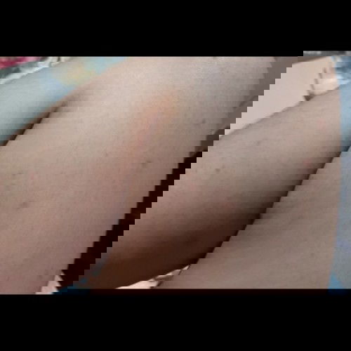 bintik bintik merah dikaki tangan