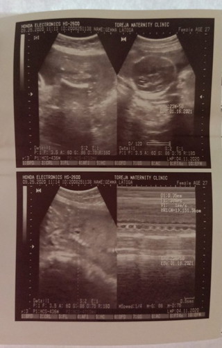 25weeks ultrasound