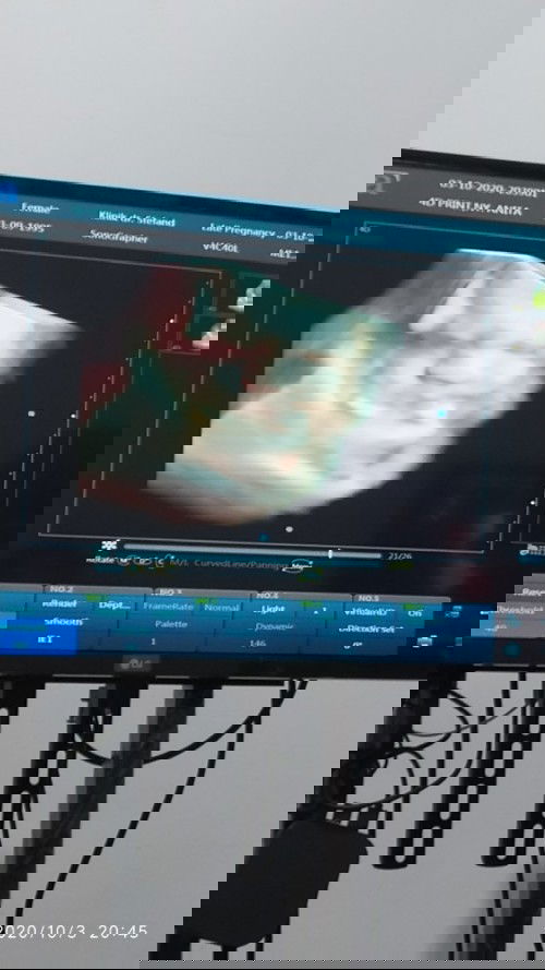 kelilit tali pusar 1x