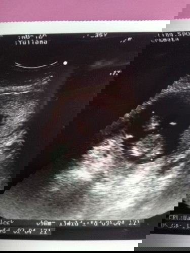 Kehamilan di usia 13-14 week