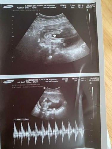 Gender ultrasound 