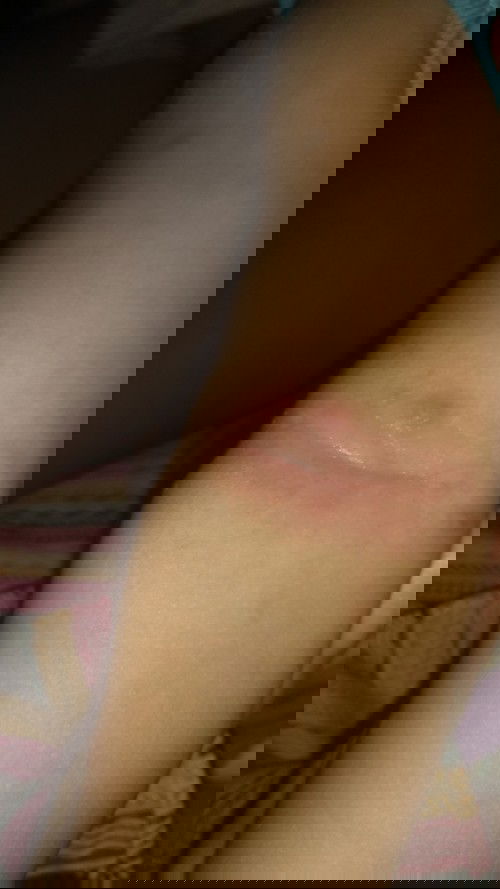 ruam bagian siku anak