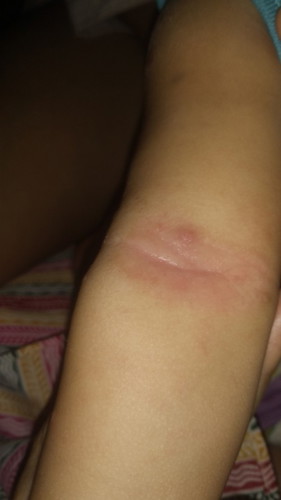 ruam bagian siku anak