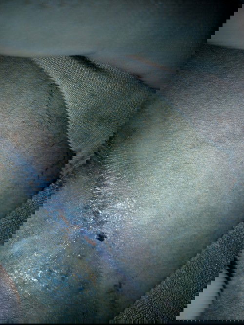 jahitan sesar bolong