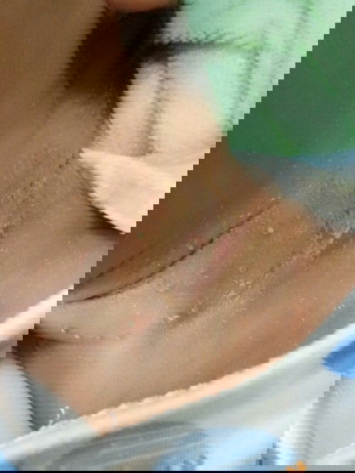 ขอสอบถามหน่อยคะ คลอดน้องได้7วันน้องเป็นผื่นขึ้นที่คอเยอะมากคะ มีกลิ่นด้วยทำยังไงถึงจะหายคะ