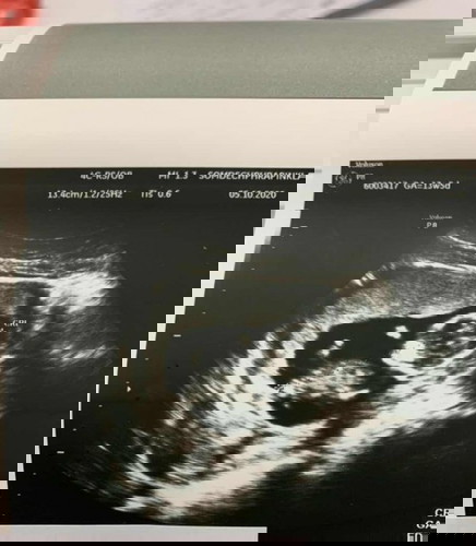 13w5d เจอตัวและเสียงหัวใจเต้นแล้วจ้า ก่อนหน้านี้ซาวไม่เจอเสียใจและกังวลมาก