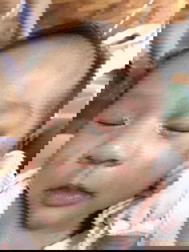 Ano po to tumutubo sa face ng baby ko?