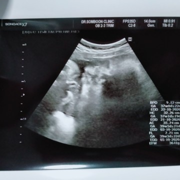 แม่ๆๆทีมตุลาแอบแตกกันหรืยังคะ บ้านนี้ 13 ตุลา ปากมดลูกเปิด 1.5 เซนเอง แม่อยากแตกแล้ว