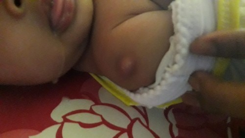 Benjolan 2 bulan setelah imunisasi