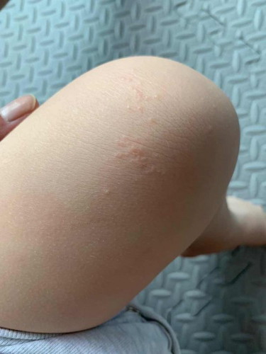 Toddler’s leg