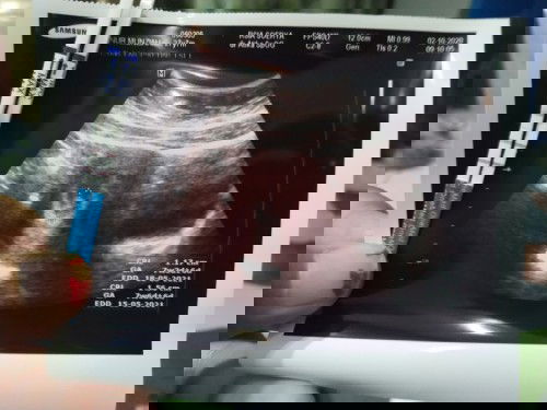 Hamil dengan hipertensi