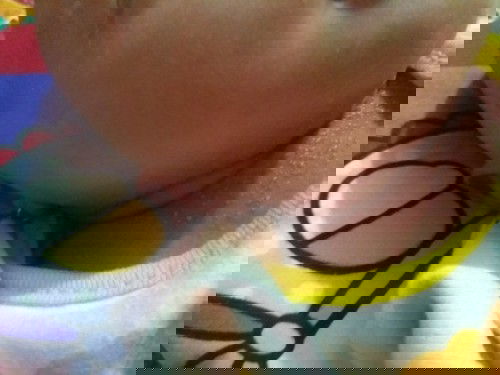 Biang Keringat / Ruam / Beruntusan